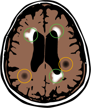 illustration of white matter hyperintensitites seen on a brain scan